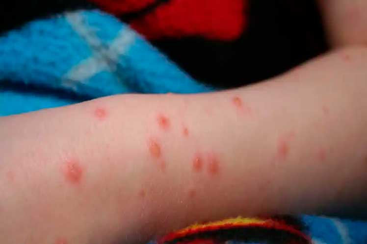 Marrocos registra primeiro caso de varíola de macaco - Prensa Latina